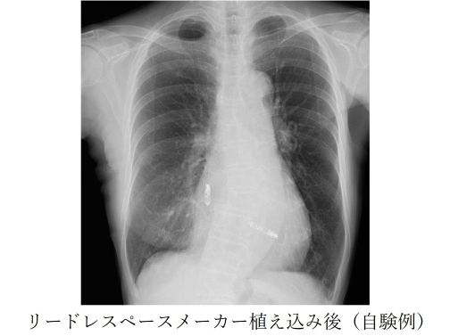 リードレスペースメーカー植え込み後(自験例)