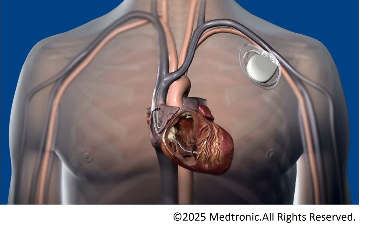 CRT-D植え込みイメージ