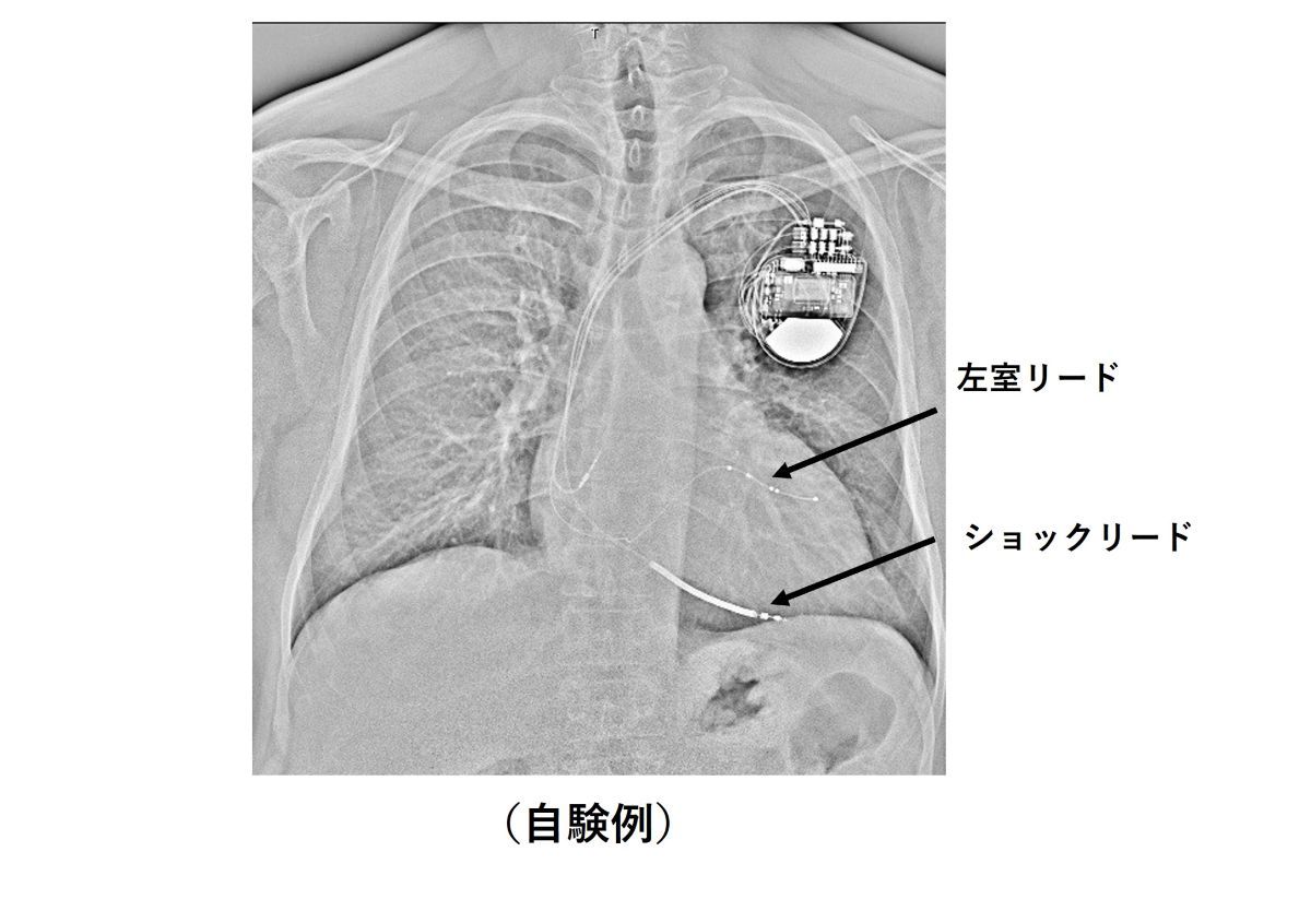 CRT-D植え込み後(自験例)