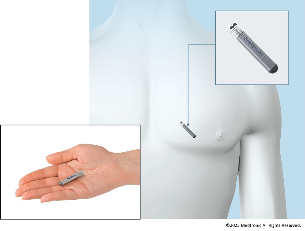 植込み型ループレコーダー(ILR)イメージ