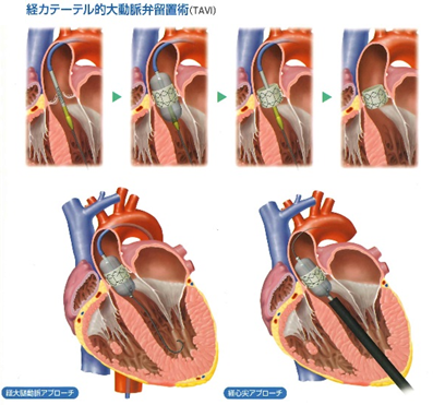 TAVIアプローチ図